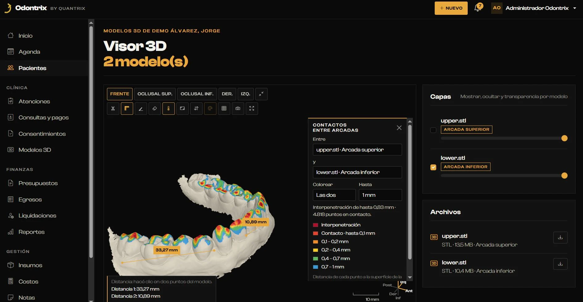 Visor 3D con las arcadas escaneadas, el mapa de contactos entre superior e inferior y mediciones en milímetros
